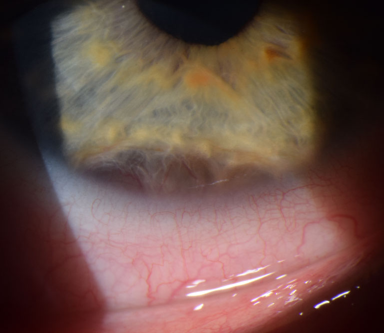 A ciliary body mass in a child with bilateral idiopathic uveitis