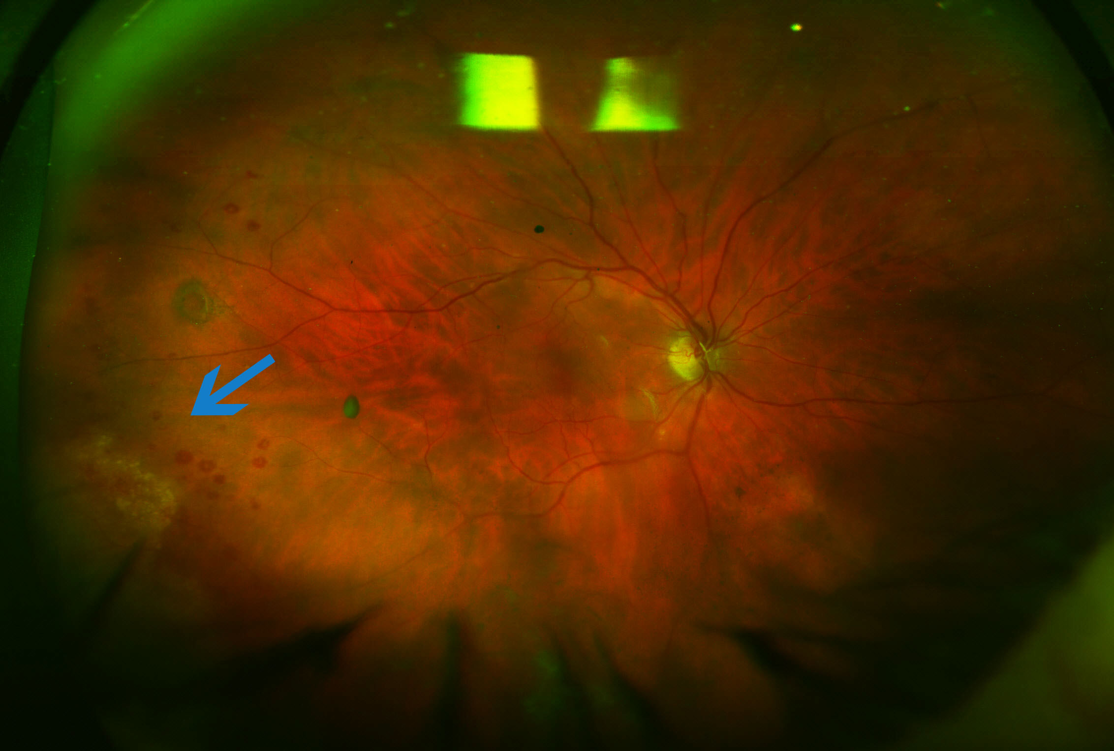 Cytomegalovirus retinitis in an elderly patient without an identifiable immune deficiency