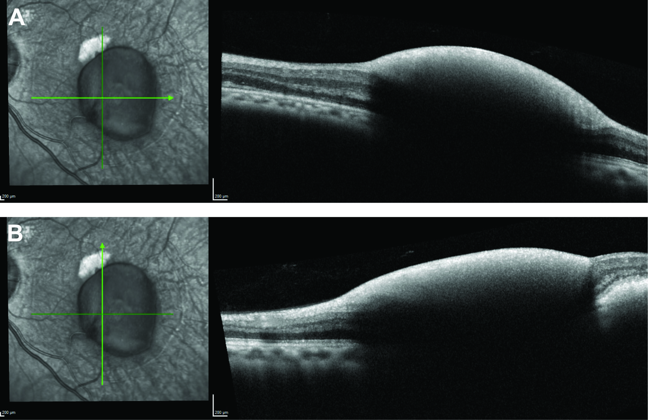 Optical coherence tomographic findings in Terson syndrome